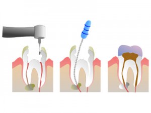 endodontie